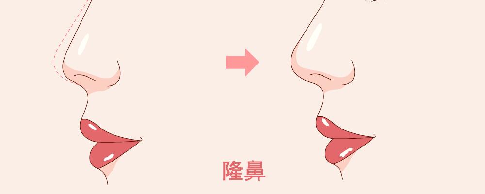 隆鼻材料要怎么选择 隆鼻的注意事项 隆鼻后如何消肿