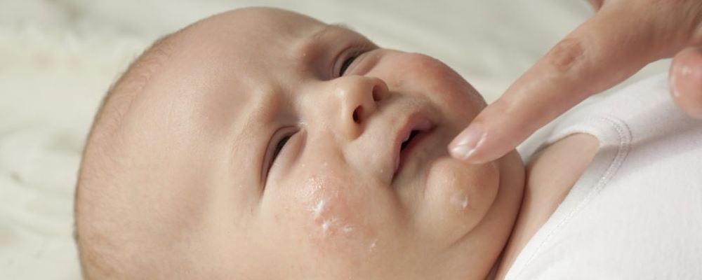 宝宝得了湿疹怎么办 湿疹如何解决 什么方法可以缓解湿疹