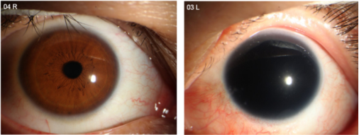 Artificial Iris人工虹膜落地国内，虹膜缺损患者享惠先行区