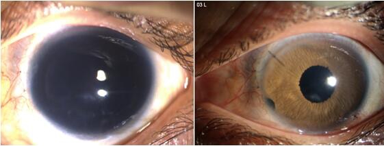 Artificial Iris人工虹膜落地国内，虹膜缺损患者享惠先行区