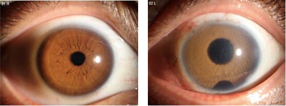 Artificial Iris˹ĤعڣĤȱ